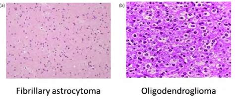 Histology of low grade gliomas. (a) The fibrillary astrocytoma shows ...