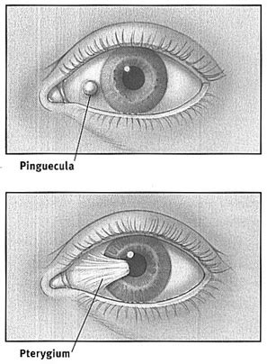 Pterygium and Pinguecula