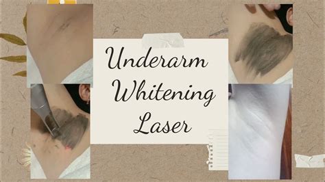 Underarm Whitening Laser / Vlog 36 - YouTube