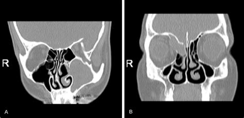 Computer Tomography Images of left maxillary sinus (A) and right... | Download Scientific Diagram