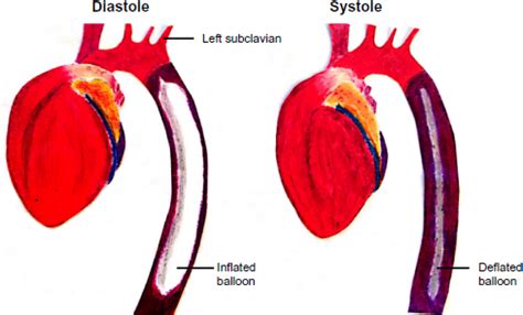 Aortic Balloon Pump Placement