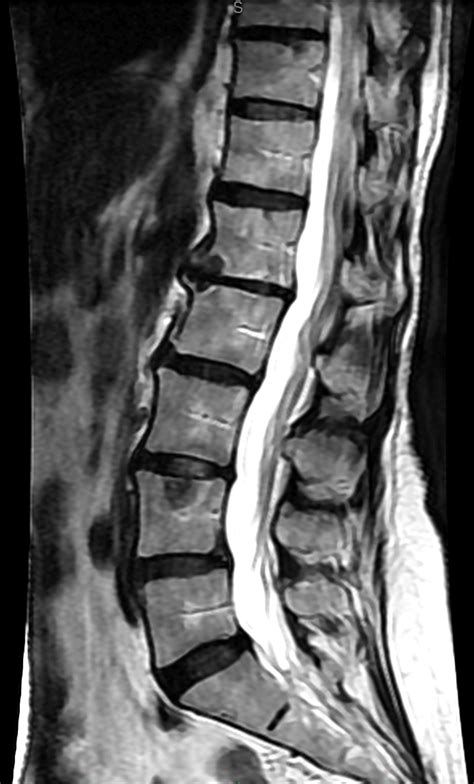 White Spots On Mri Lumbar Spine