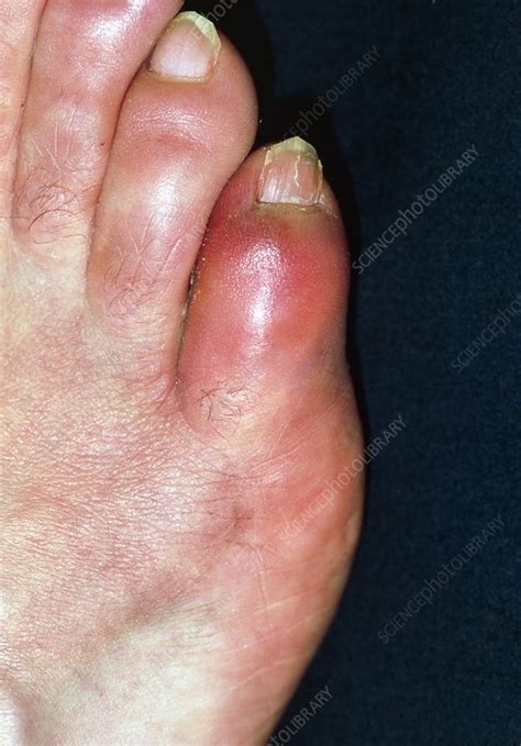 Close-up of red and swollen fractured little toe - Stock Image - M330/0656 - Science Photo Library