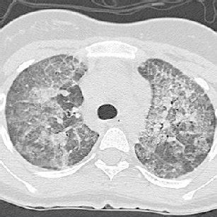 CT lung scan showing crazy paving pattern | Download Scientific Diagram