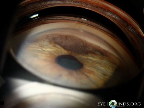 Iris Melanoma :: The University of Iowa, Ophthalmology