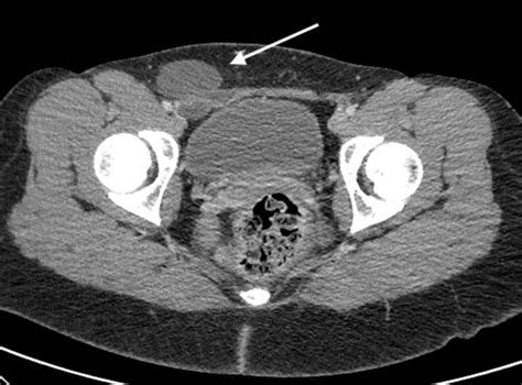 Figure 1 from Hydrocele in the Canal of Nuck - CT appearance of a developmental groin anomaly ...