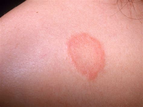 Ringworm in babies | BabyCenter