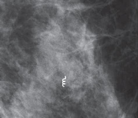 Metal clip marking the biopsy site. | Download Scientific Diagram