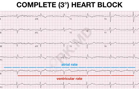Complete (3°) Heart Block EKG | RK.MD