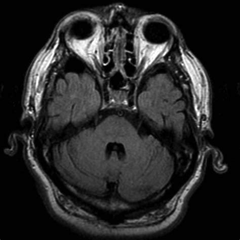 Arachnoid cyst - middle cranial fossa | Image | Radiopaedia.org