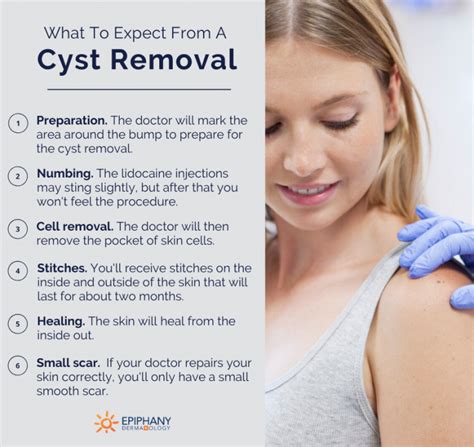 what to expect from cyst removal | Epiphany Dermatology