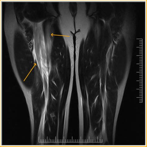 Biceps Femoris Tear-MRI - Sumer's Radiology Blog