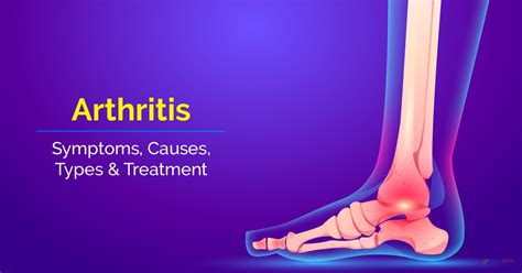 Arthritis: Symptoms, Causes, Types & Treatment |Skedoc