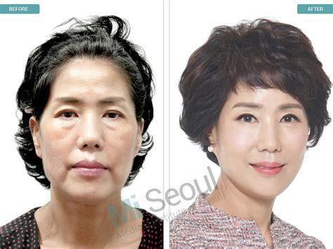 Korea Plastic Surgery Before and After photos