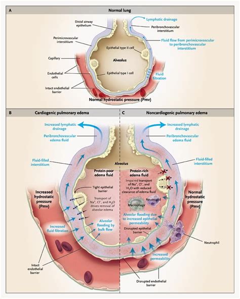 Cardiogenic Pulmonary Oedema. Management.