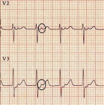 Retrograde P waves in Fast-Slow AVNRT | Education blog, Emergency medicine, P wave