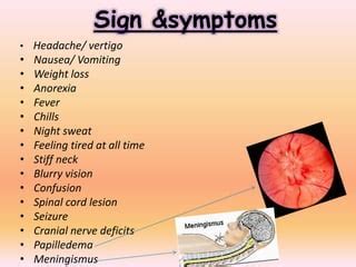 Tuberculoma | PPT