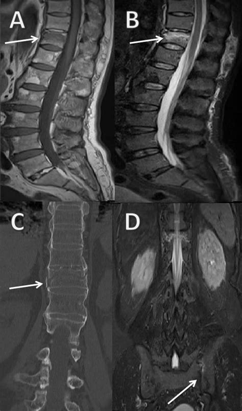 T11 vertebra fracture in ankylosing spondylitis after minor trauma - The Spine Journal