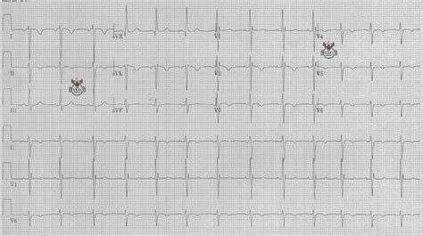 ECG Basics & Fundamentals: ECG findings of dextrocardia – ECG Weekly