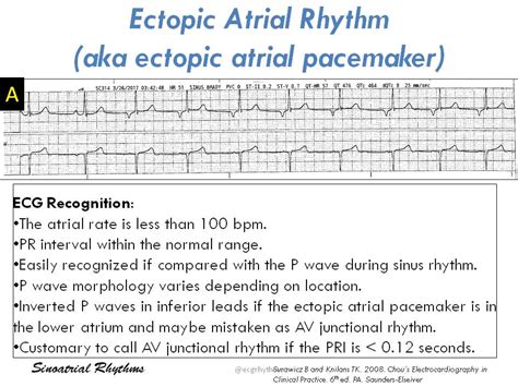 Atrial Rhythm