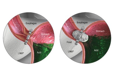 LINX Reflux Management System | Ethicon