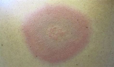 Lyme Disease - Rash, Causes, Symptoms, Diagnosis and Treatment