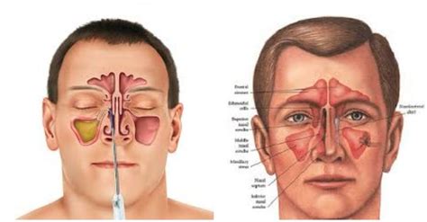 Reduce Sinus Infection Symptoms With This Natural Recipe | Sinus ...