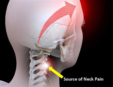 Occipital Neuralgia