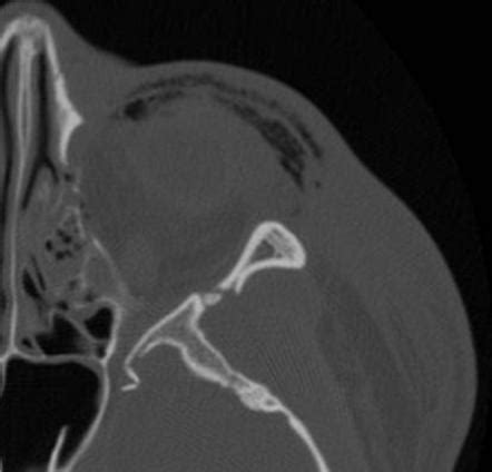 Zygomaticomaxillary complex fracture | Radiology Case | Radiopaedia.org