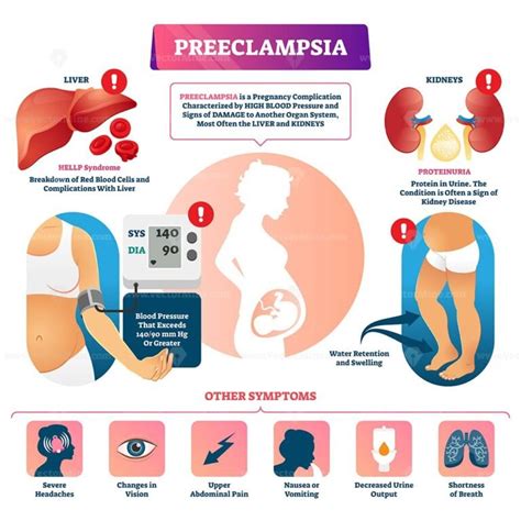 Preeclampsia vector illustration - VectorMine