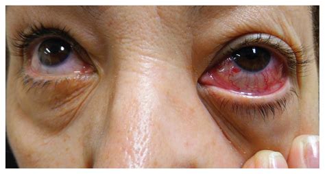 A woman with a red eye from a carotid–cavernous sinus fistula | CMAJ