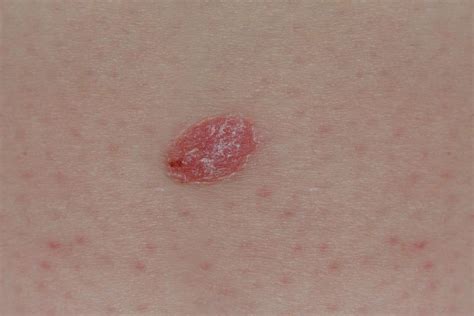 Psoriasis or skin cancer? How to tell the difference