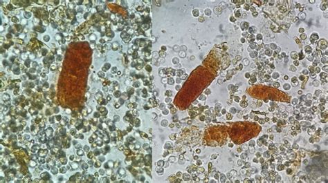 Urine Sediment of the Month: Pigmented Casts & What Those Pretty Colors Tell Us - Renal Fellow ...