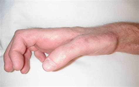 Claw hand causes, signs, symptoms, diagnosis and claw hand treatment