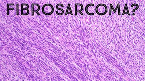 Fibrosarcoma & Herringbone Pattern Explained in 5 Minutes (pathology sarcoma dermpath) - YouTube