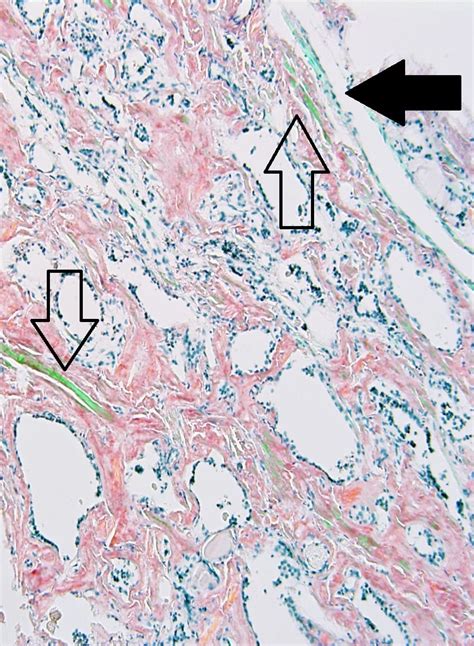 Pathology Outlines - Congo red