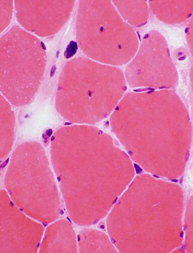 Myotonic dystrophy: Pathology