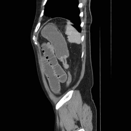 Colon cut-off sign | Image | Radiopaedia.org