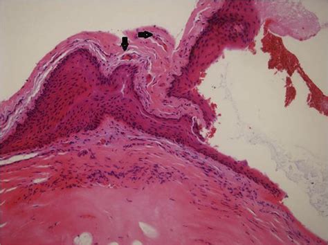 A histological section of the corneal lesion showed that the corneal ...