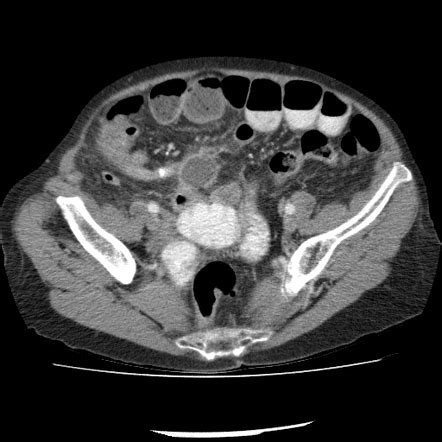 Radiopaedia Appendicitis Ultrasound Appendicitis is inflammation of the ...