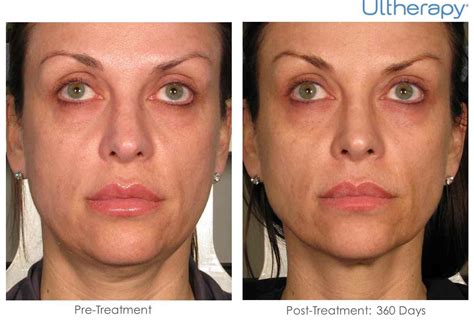 Ulthera (Ultherapy) Comes To Ethos Spa, Skin and Laser Center in New ...