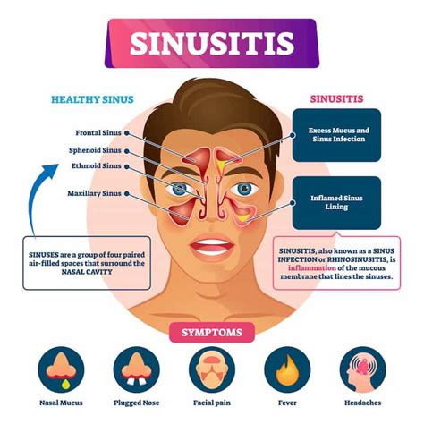 6 Common Symptoms of Chronic Sinusitis To Watch Out For