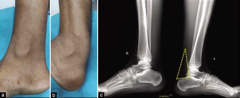 Soleus Muscle Strain