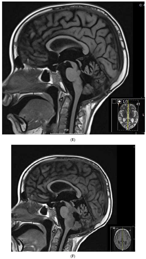 JCM | Free Full-Text | Cyclic Metronomic Chemotherapy for Pediatric Tumors: Six Case Reports and ...