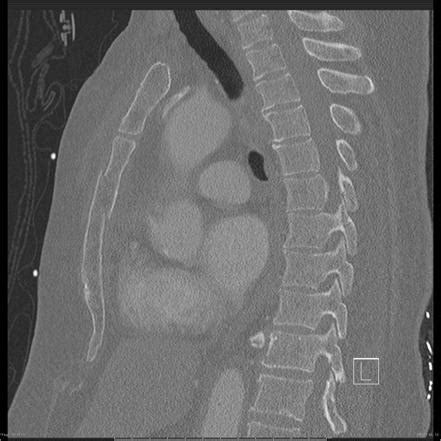 Sternal fracture | Radiology Reference Article | Radiopaedia.org