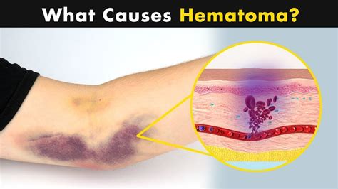 Hematoma | What happened symptoms and treatment - YouTube