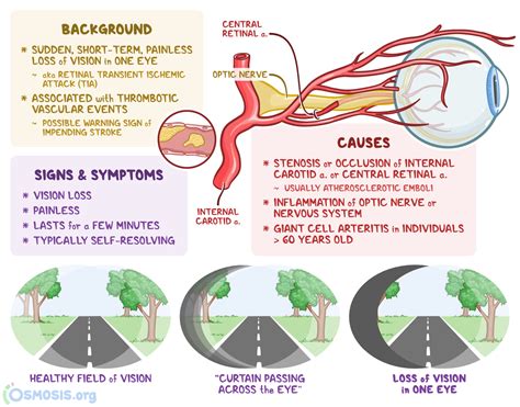 Amaurosis Fugax: What is it, Causes and More | Osmosis