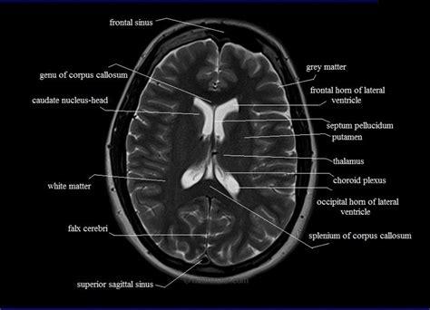 Ct Scan Brain Anatomy : Anatomy Of Head Ct Scan Normal The Brain On Ct And Mri ... / Frontal ...