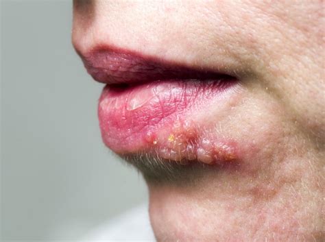 Shingles on the face: Symptoms, treatment, and causes