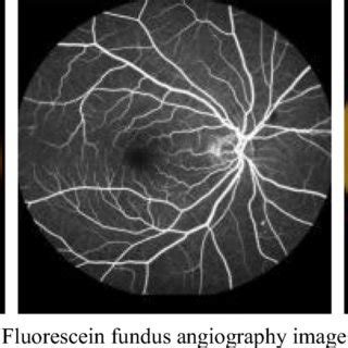 Fluorescein fundus angiography image and color fundus image registration | Download Scientific ...